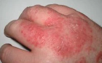 eczema